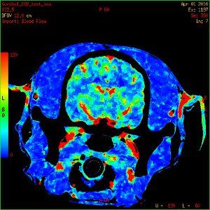 Dynamic perfusion CT (A)